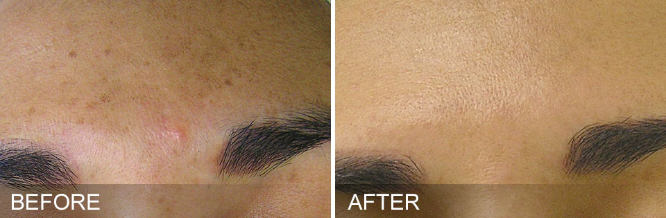 Cosmedic Hautreinigung Vorher Nachher Stirn